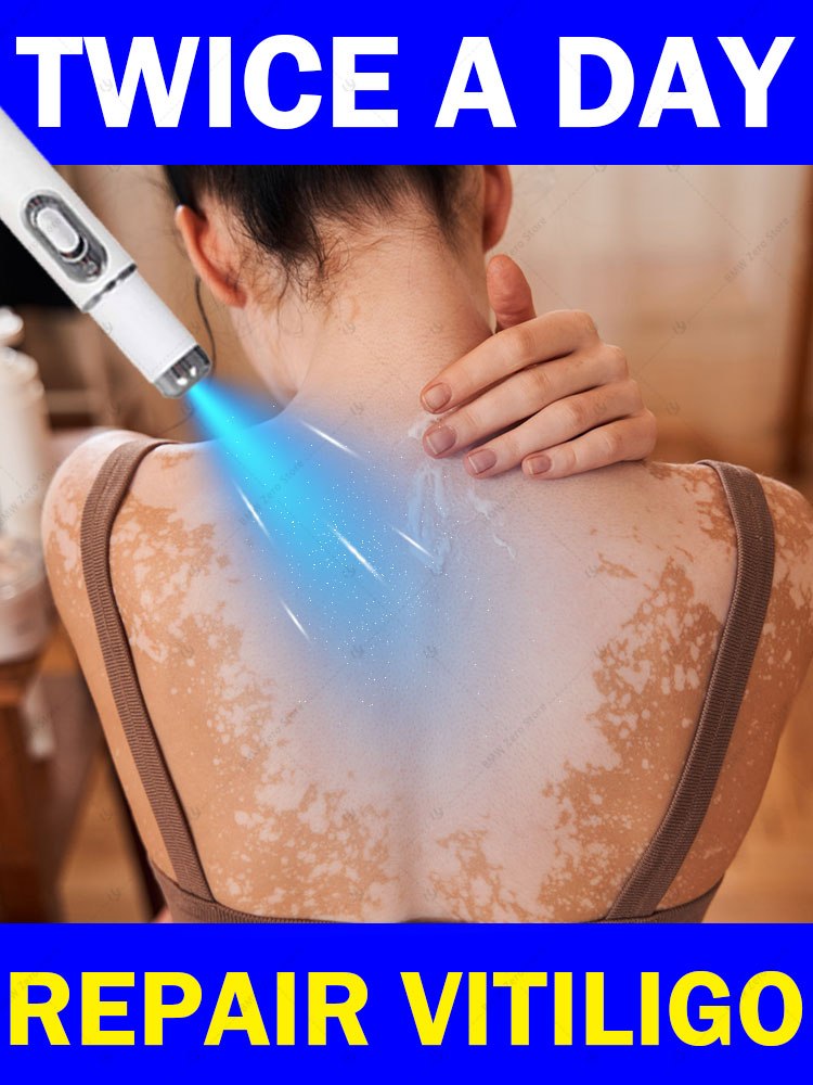 A nova tecnologia de laser TR 2025 melhora efetivamente o vitiligo